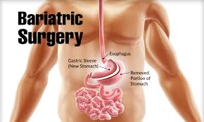 Health Problems That Bariatric Surgery Can Improve