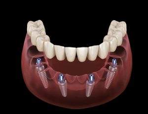 When to Get All On 4 Dental Implants - Cosmetic Dentistry Clinic