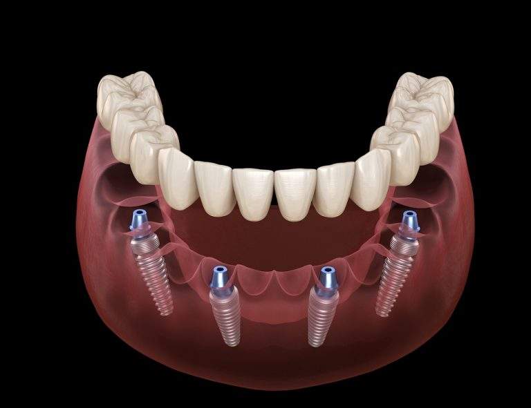 When to Get All On 4 Dental Implants