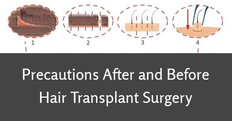 Precautions After and Before Hair Transplant Surgery